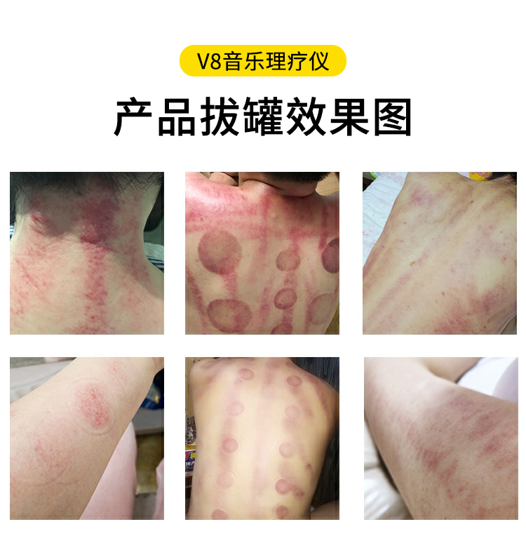 V8音樂理(lǐ)療儀拔罐效果圖